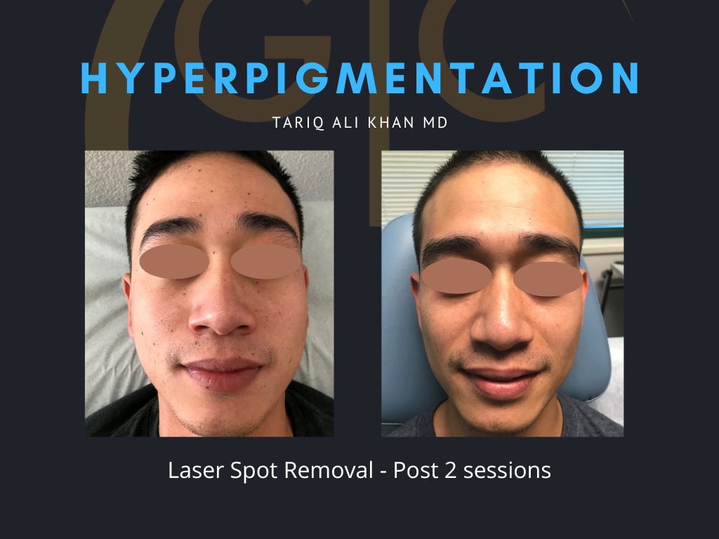 Gentle Care Laser Tustin Before and After picture - Sunspot treatment